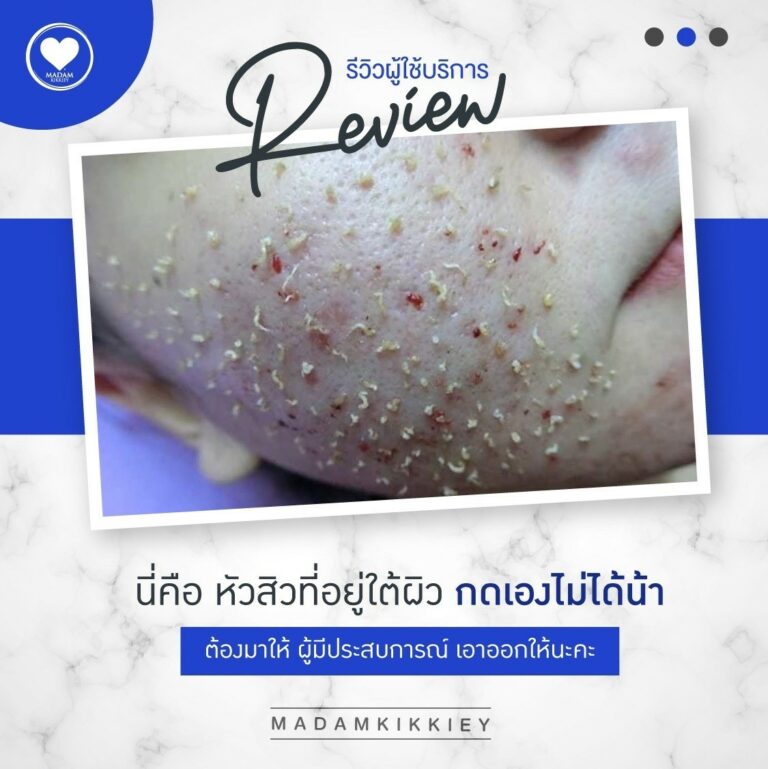 13.1 อุดตัน