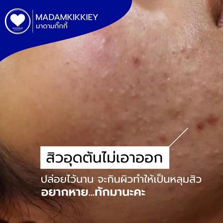 13.2 อุดตัน
