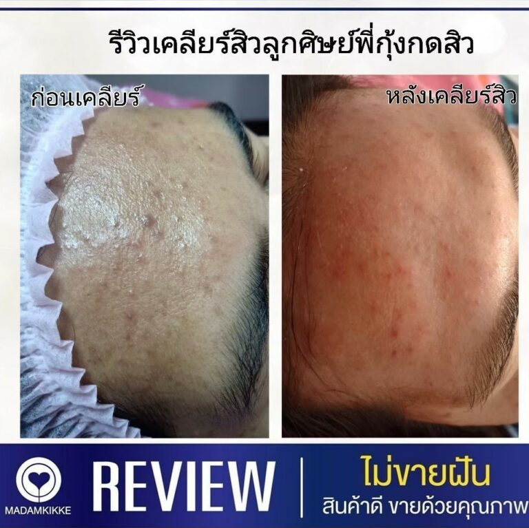 13.3 อุดตัน