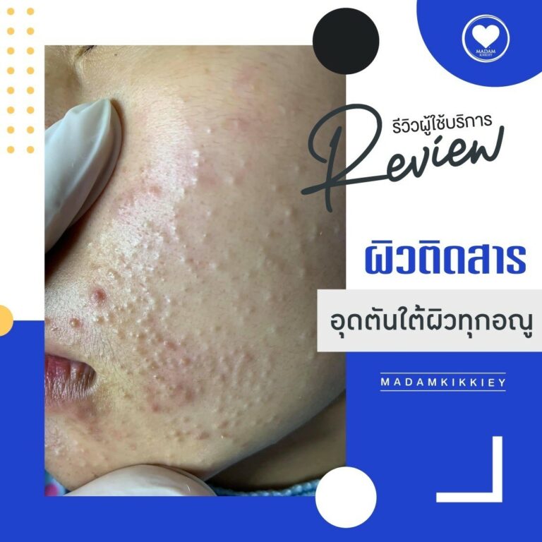 9.3 ติดสาร 4